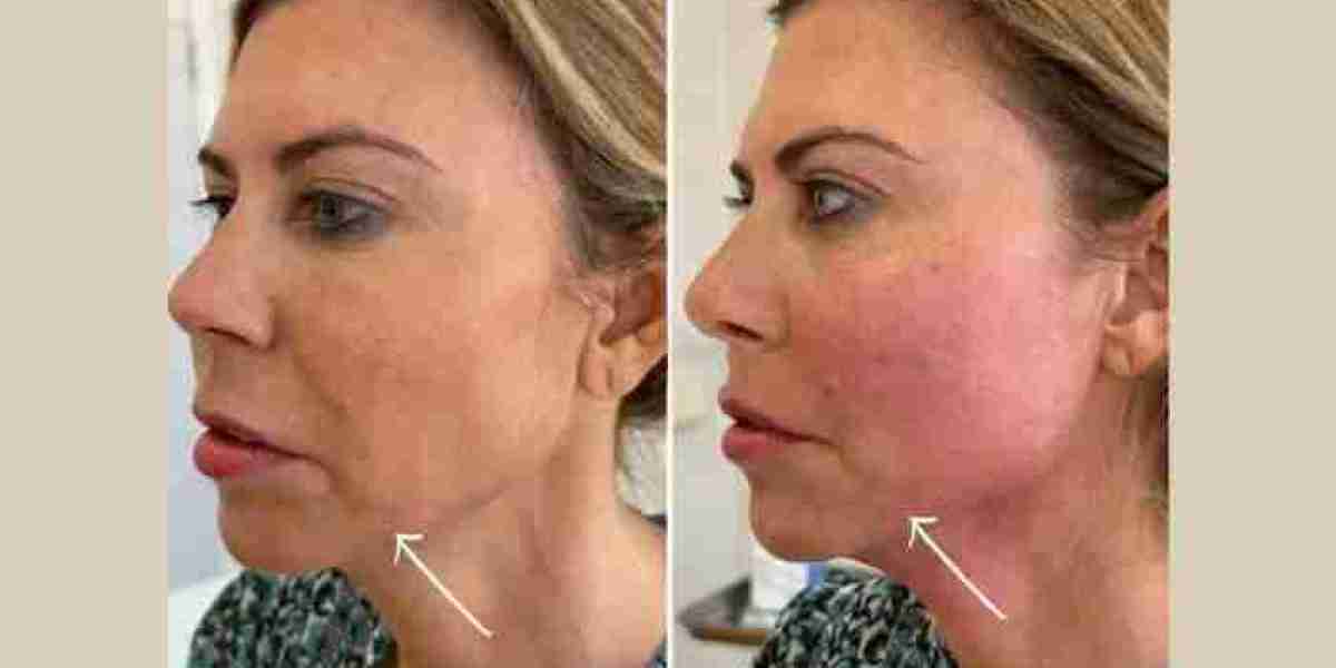 Endolift Treatment in Dubai for Advanced Laser Skin Treatments