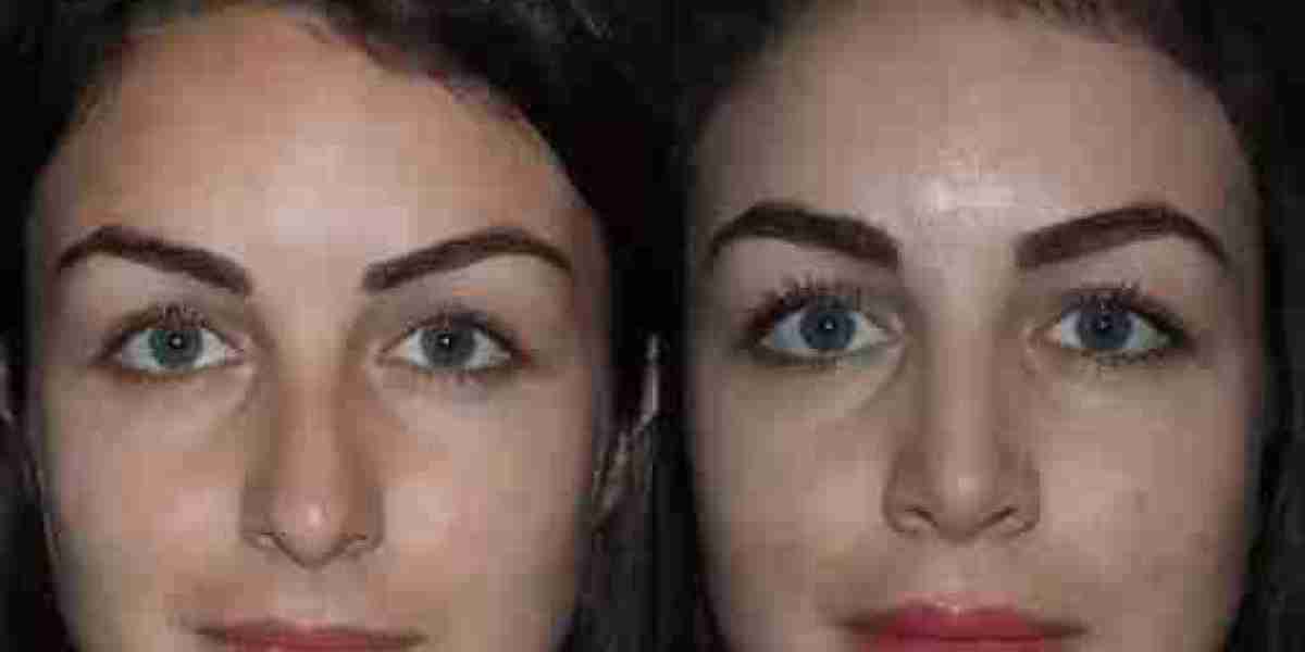 Best Doctors in Dubai for Rhinoplasty and Modern Surgical Excellence